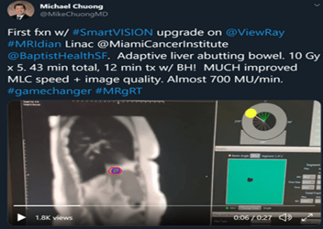 Treatment of difficult Liver Cancer (adjacent to bowel) in 5 adaptive fractions each of 10Gy, 12-minute treatment time, 43-minute session